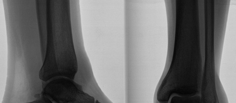 foot and leg x-ray