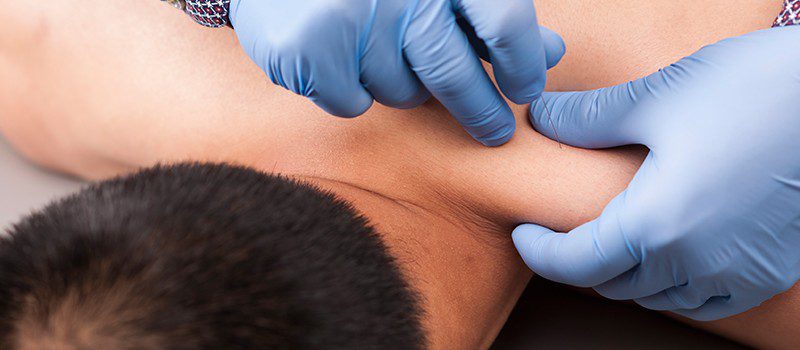 Dry Needling Mesa AZ, Intramuscular Stimulation (IMS)