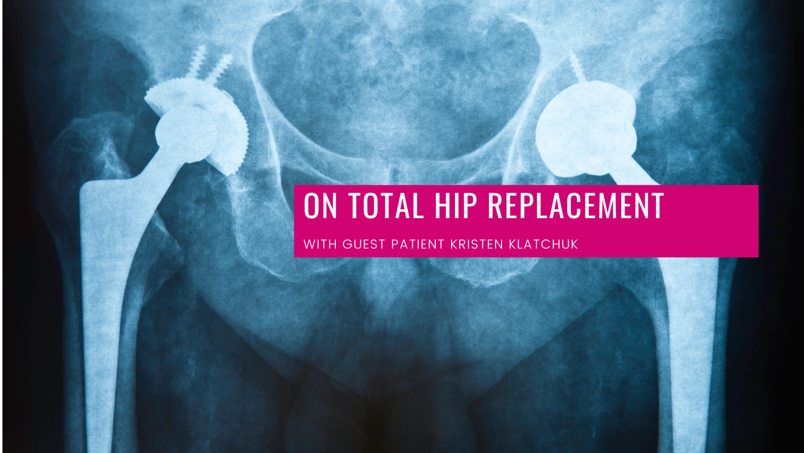 Listen On Total Hip Replacement With Kristen Klatchuk Leading Edge